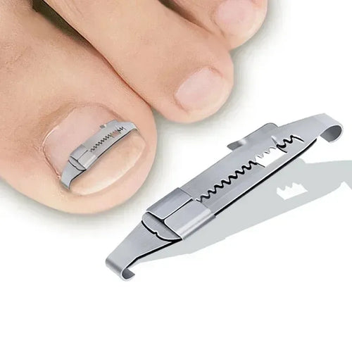 1PC Ingrown Toenail Corrector Tools Pedicure Recover Embed Toe Nail Treatment Professional Ingrown Toenail Correction Foot Care