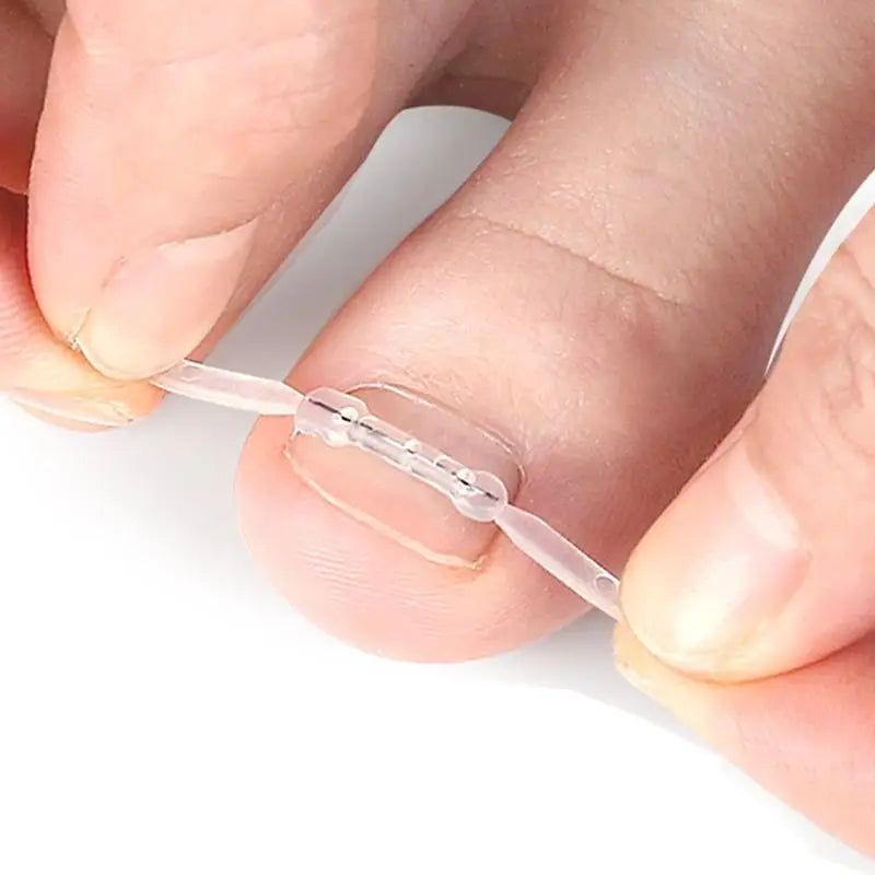 Professional Ingrown Toenail Corrector Tool Pedicure Toe Nail Treatment Embed Straightening Clip Brace for Recovering Foot Care