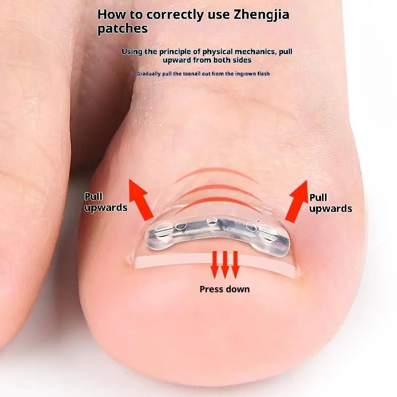 Professional Ingrown Toenail Corrector Tool Pedicure Toe Nail Treatment Embed Straightening Clip Brace for Recovering Foot Care