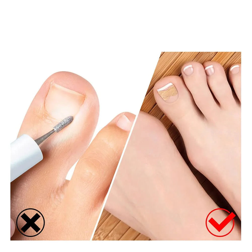 Ingrown Toenail Corrector Straightening Clip Pedicure Foot Nail Care Tools Stainless Steel Pedicure Treatment Onyxis Correction