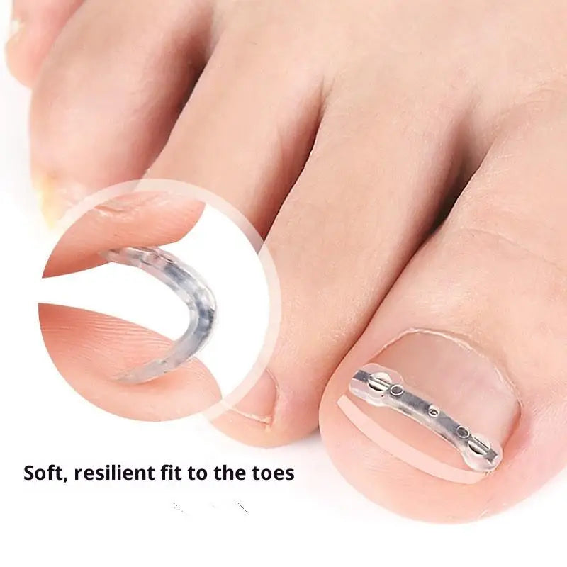 Professional Ingrown Toenail Corrector Tool Pedicure Toe Nail Treatment Embed Straightening Clip Brace for Recovering Foot Care