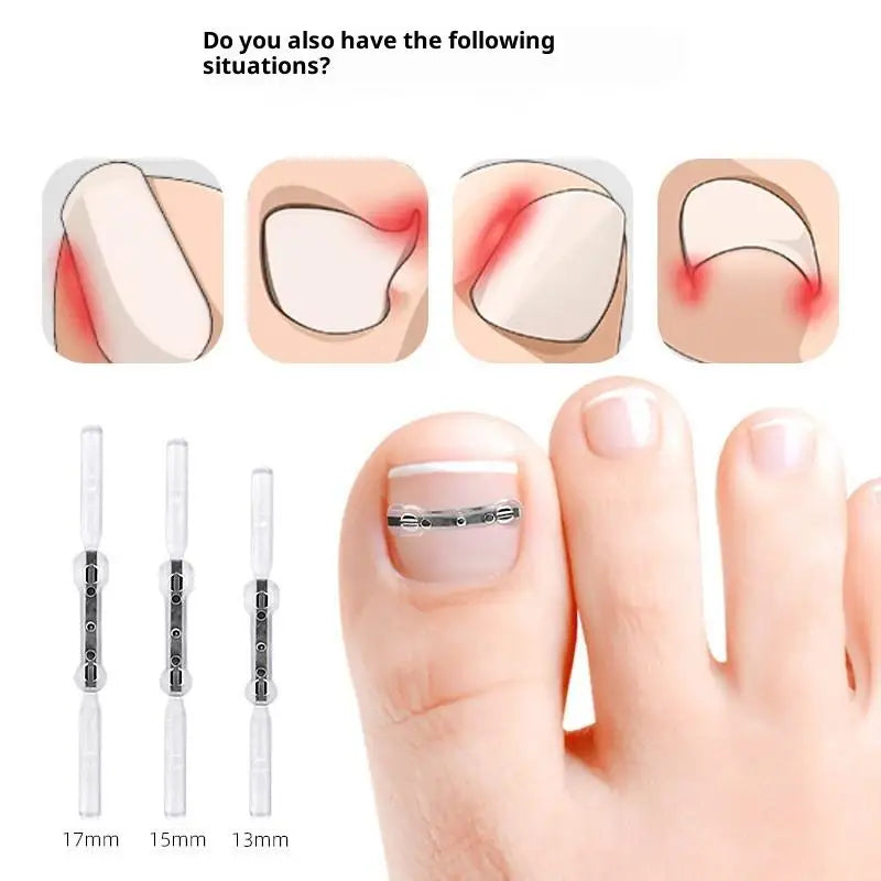 Professional Ingrown Toenail Corrector Tool Pedicure Toe Nail Treatment Embed Straightening Clip Brace for Recovering Foot Care