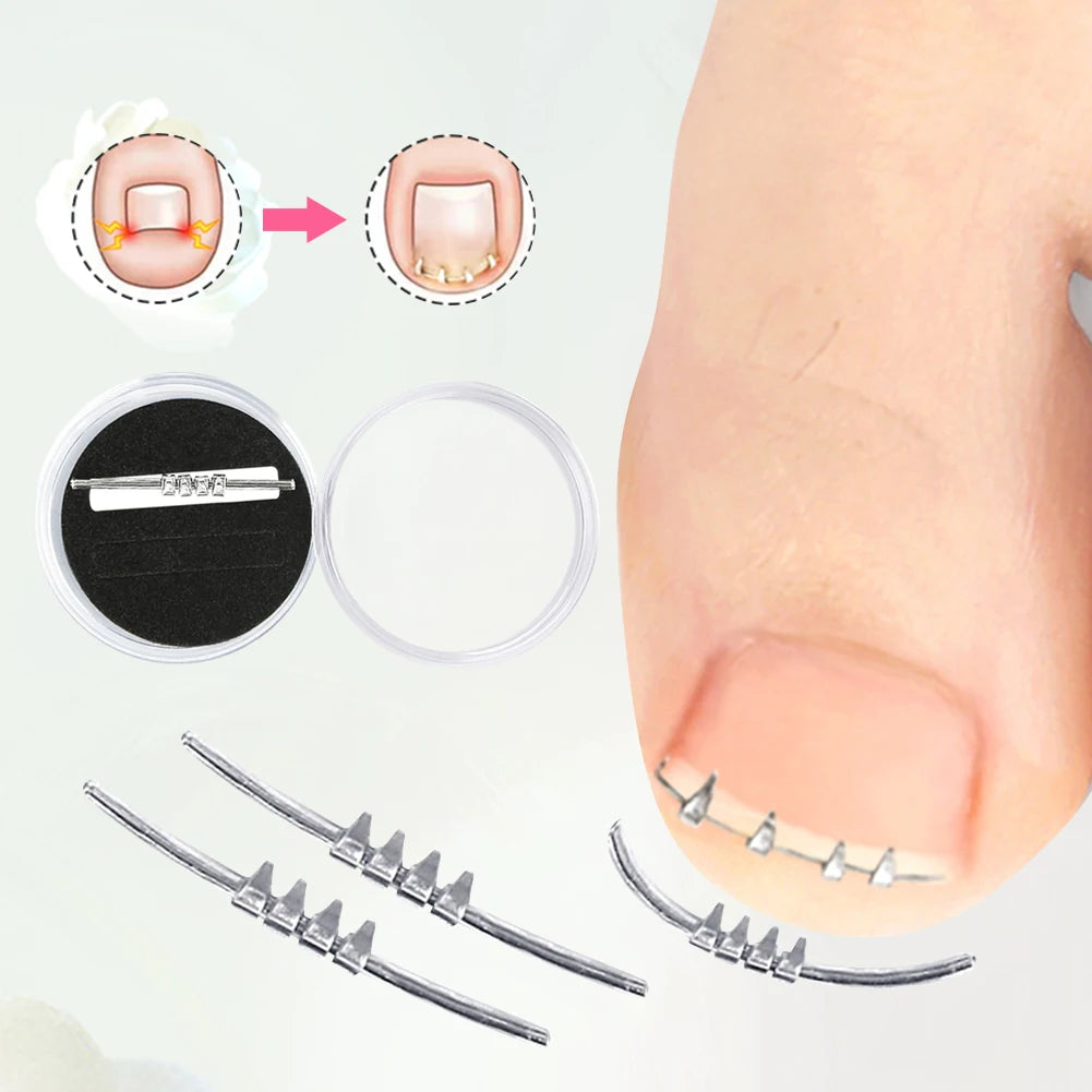 Ingrown Toenail Corrector Tool Embed Toe Nail Care Ingrown Toenail Pedicure Tool Curved Clamp Toenails Correction Tool