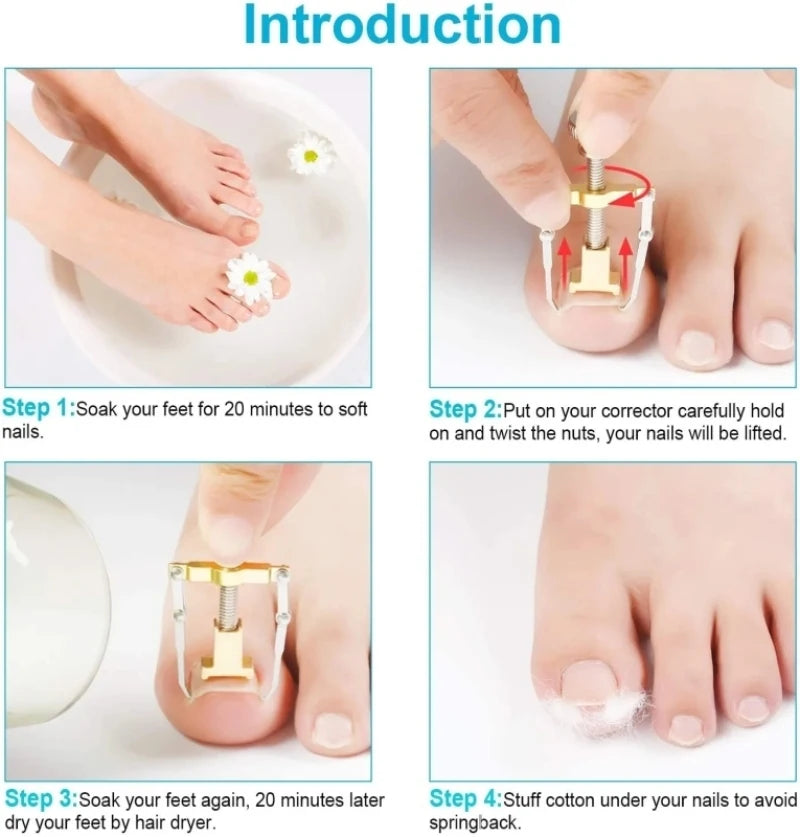 Correction of Paronychia with Toe Nail Correction Bracket for Treatment of Toe and Toe Care with Toe Fixator