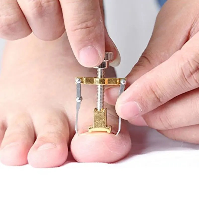 Correction of Paronychia with Toe Nail Correction Bracket for Treatment of Toe and Toe Care with Toe Fixator