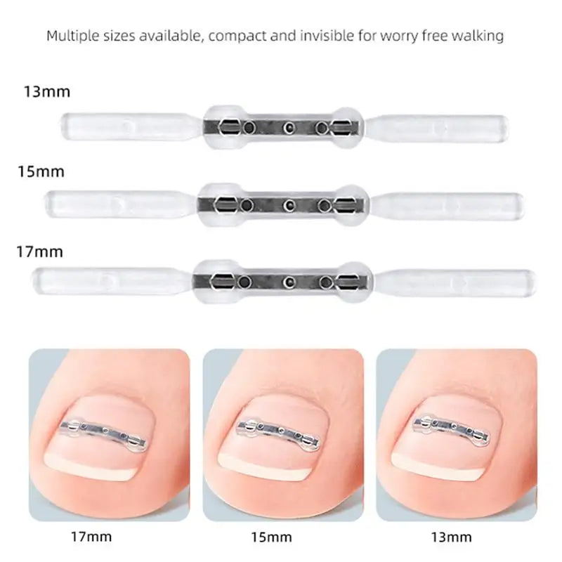 Professional Ingrown Toenail Corrector Tool Pedicure Toe Nail Treatment Embed Straightening Clip Brace for Recovering Foot Care