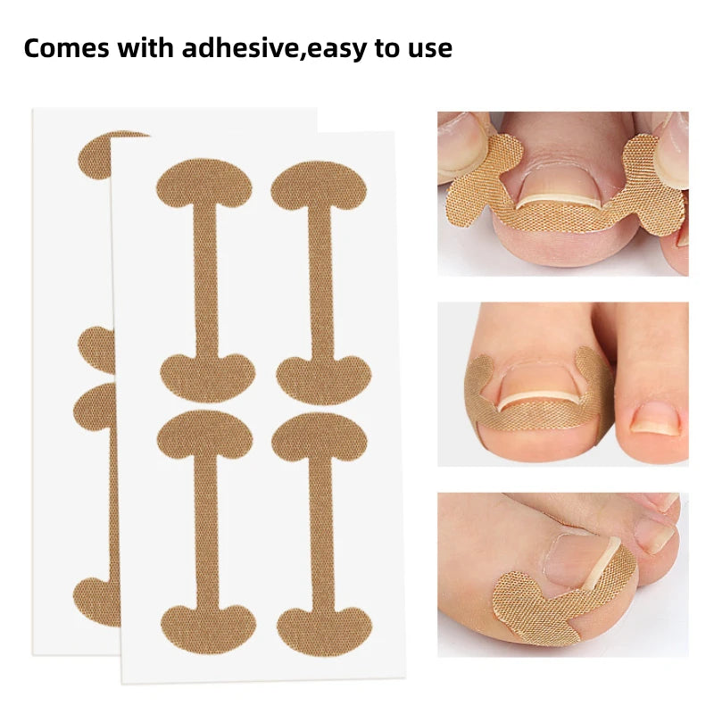4Pcs/8Pcs/12Pcs Nail Correction Stickers Ingrown Toenail Corrector Patches Treatment Recover Corrector Foot Pedicure Care Tool