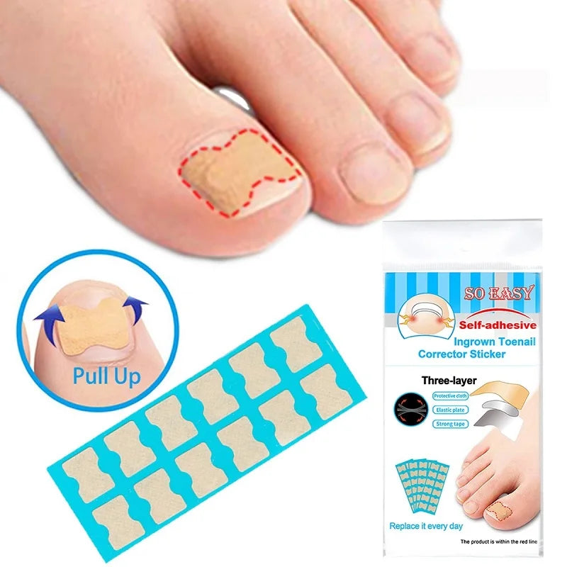 Nails Correction Patches Ingrown Toenail Corrector Toenail Separator Ingrown Correction Tool Ingrown Toenail Correction Patches