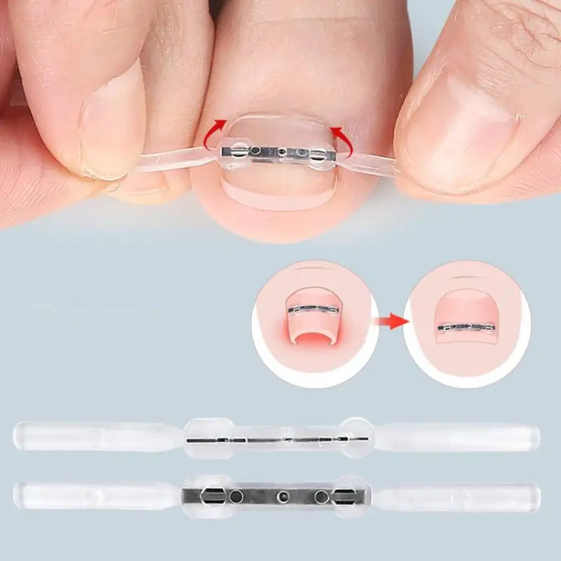 Professional Ingrown Toenail Corrector Tool Pedicure Toe Nail Treatment Embed Straightening Clip Brace for Recovering Foot Care