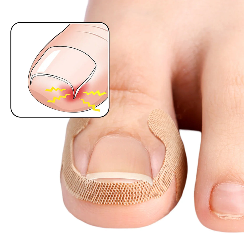 20/40/60pcs Waterproof Nail Correction Stickers Ingrown Toenail Corrector Patches Treatment Recover Corrector Pedicure Care Tool