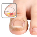 20/40/60pcs Waterproof Nail Correction Stickers Ingrown Toenail Corrector Patches Treatment Recover Corrector Pedicure Care Tool