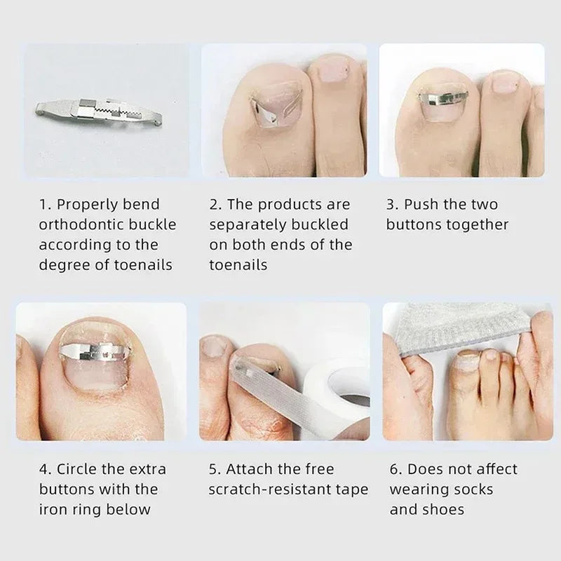 1PC Ingrown Toenail Corrector Tools Pedicure Recover Embed Toe Nail Treatment Professional Ingrown Toenail Correction Foot Care