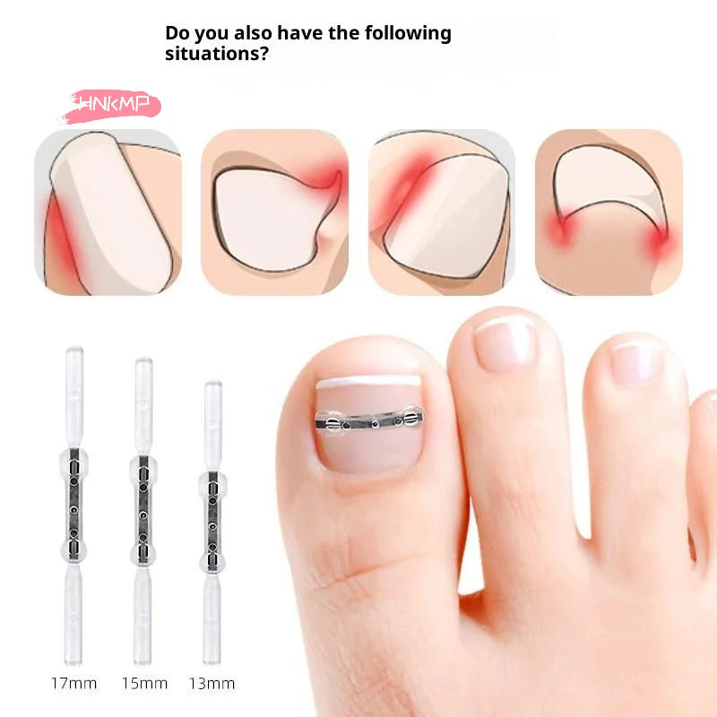 Professional Ingrown Toenail Corrector Tool Pedicure Toe Nail Treatment Embed Straightening Clip Brace for Recovering Foot Care