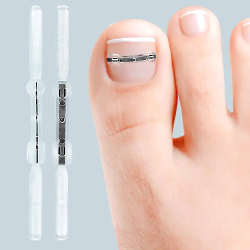 Professional Ingrown Toenail Corrector Tool Pedicure Toe Nail Treatment Embed Straightening Clip Brace for Recovering Foot Care