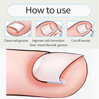 Ingrown Toenail Correction Tool Nail Filling Pad Ingrown Toe Nail Treatment Elastic Patch Straightening Clip Brace Pedicure Tool