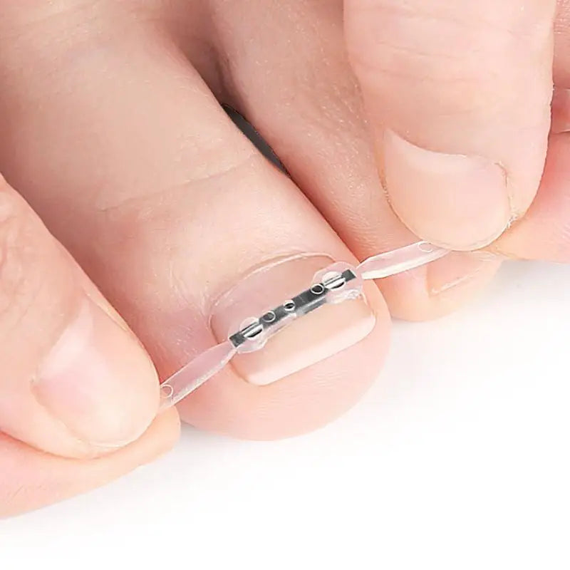 Professional Ingrown Toenail Corrector Tool Pedicure Toe Nail Treatment Embed Straightening Clip Brace for Recovering Foot Care