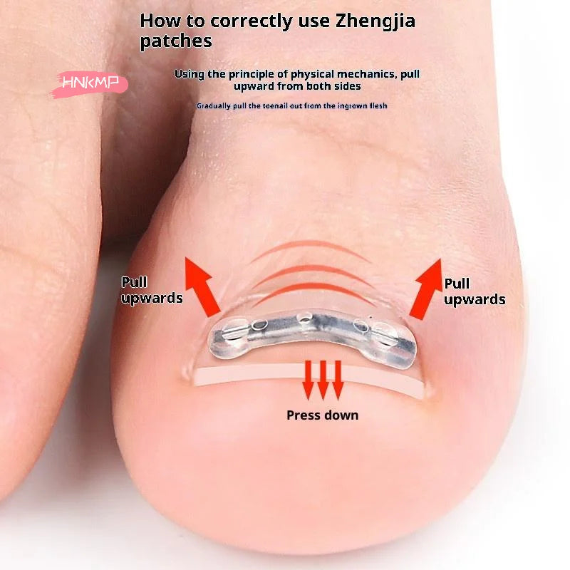 Professional Ingrown Toenail Corrector Tool Pedicure Toe Nail Treatment Embed Straightening Clip Brace for Recovering Foot Care