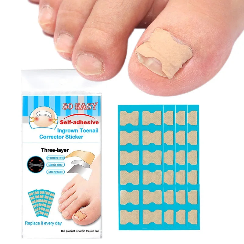 Nails Correction Patches Ingrown Toenail Corrector Toenail Separator Ingrown Correction Tool Ingrown Toenail Correction Patches