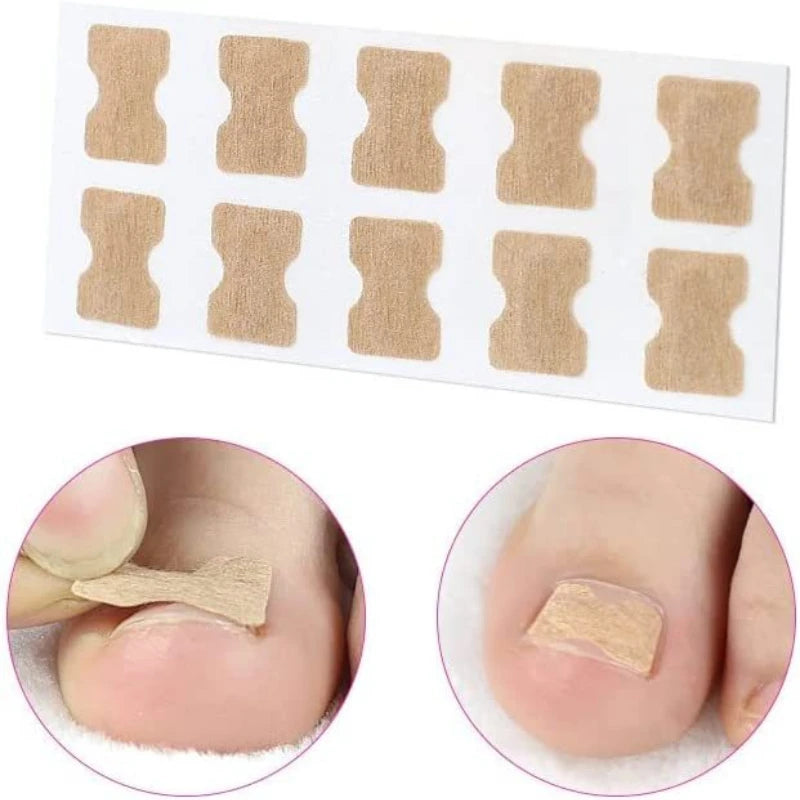 Ingrown Toenail Corrector Straightening Clip Pedicure Foot Nail Care Tools Stainless Steel Pedicure Treatment Onyxis Correction