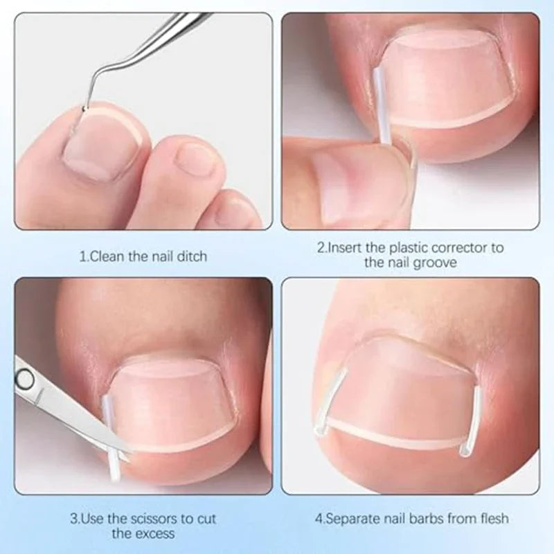 Nail Correction Set Ingrown Toenail Correction Patch Stickers Corrector Pedicure Tool Ingrown Toe Nail Treatment Foot Care