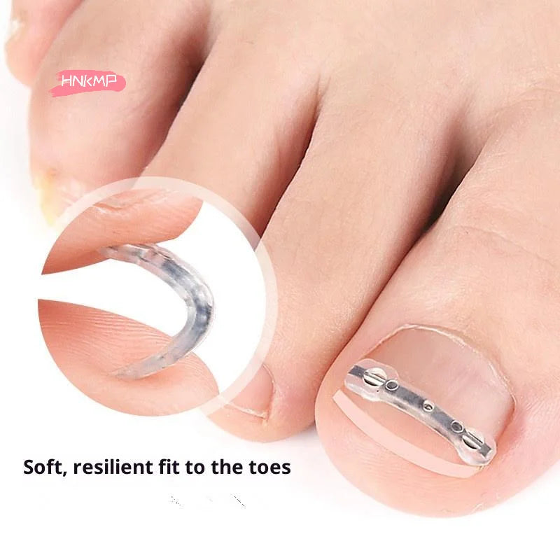 Professional Ingrown Toenail Corrector Tool Pedicure Toe Nail Treatment Embed Straightening Clip Brace for Recovering Foot Care