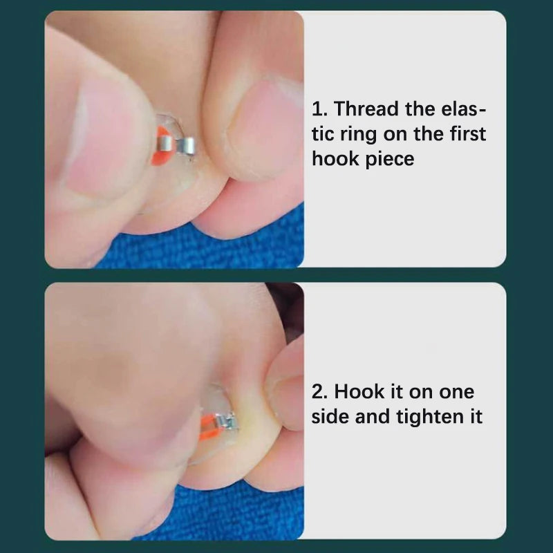 Ingrown Toenail Corrector Pedicure Recover Embed Toe Nail Treatment Professional Foot Correction Patch Stickers Care Tool