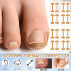 Nail Correction Set Ingrown Toenail Correction Patch Stickers Corrector Pedicure Tool Ingrown Toe Nail Treatment Foot Care
