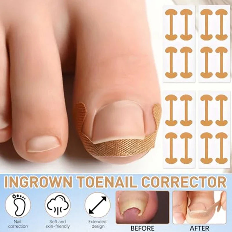 Nail Correction Set Ingrown Toenail Correction Patch Stickers Corrector Pedicure Tool Ingrown Toe Nail Treatment Foot Care