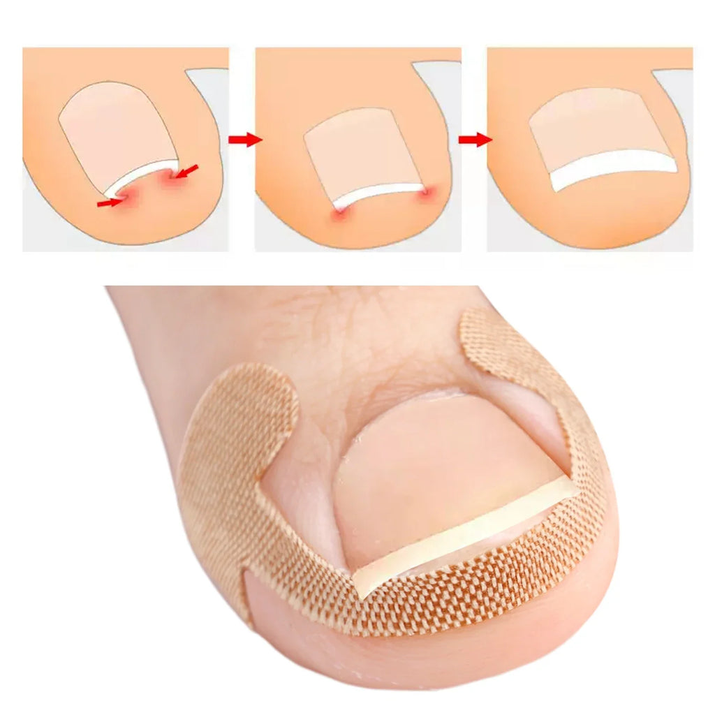 20/40/60pcs Waterproof Nail Correction Stickers Ingrown Toenail Corrector Patches Treatment Recover Corrector Pedicure Care Tool
