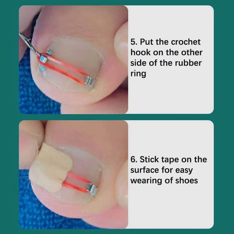 Ingrown Toenail Corrector Pedicure Recover Embed Toe Nail Treatment Professional Foot Correction Patch Stickers Care Tool